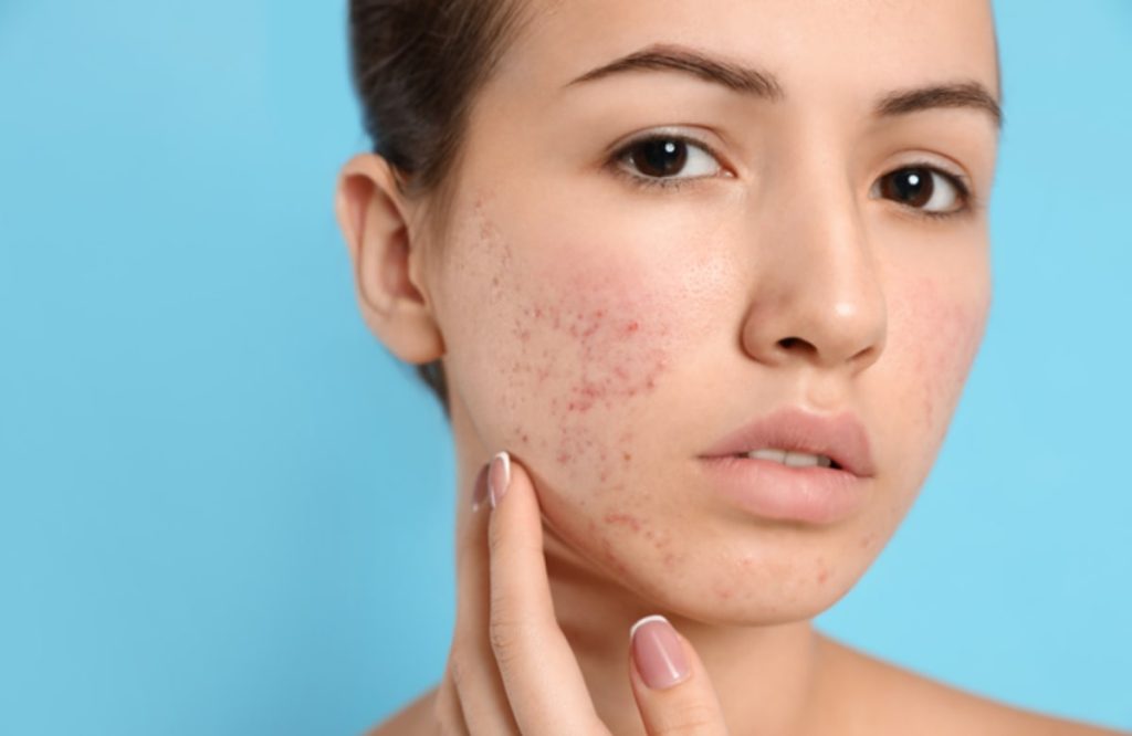 Cause And Remedies For Acne On Face