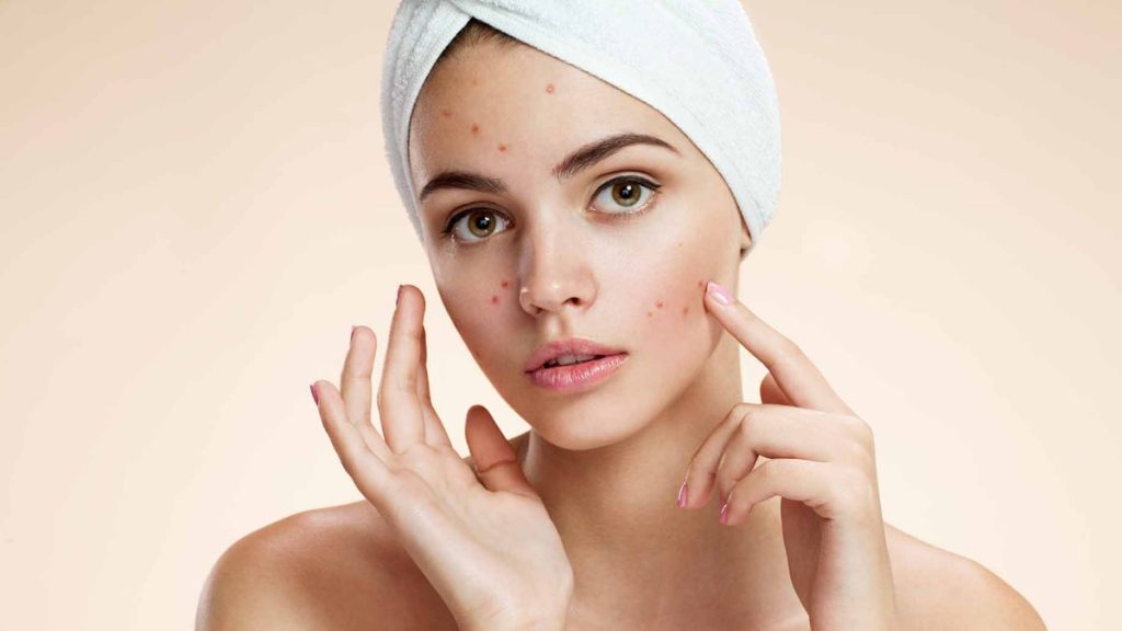 Cause And Remedies For Acne On Face