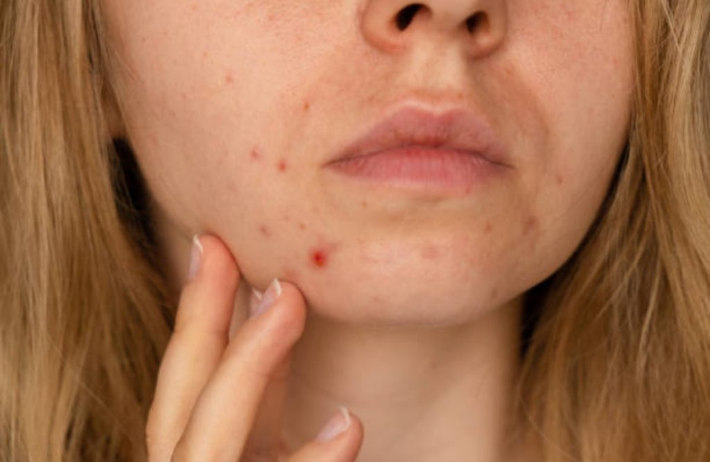 Tips For Preventing Marks On Face 