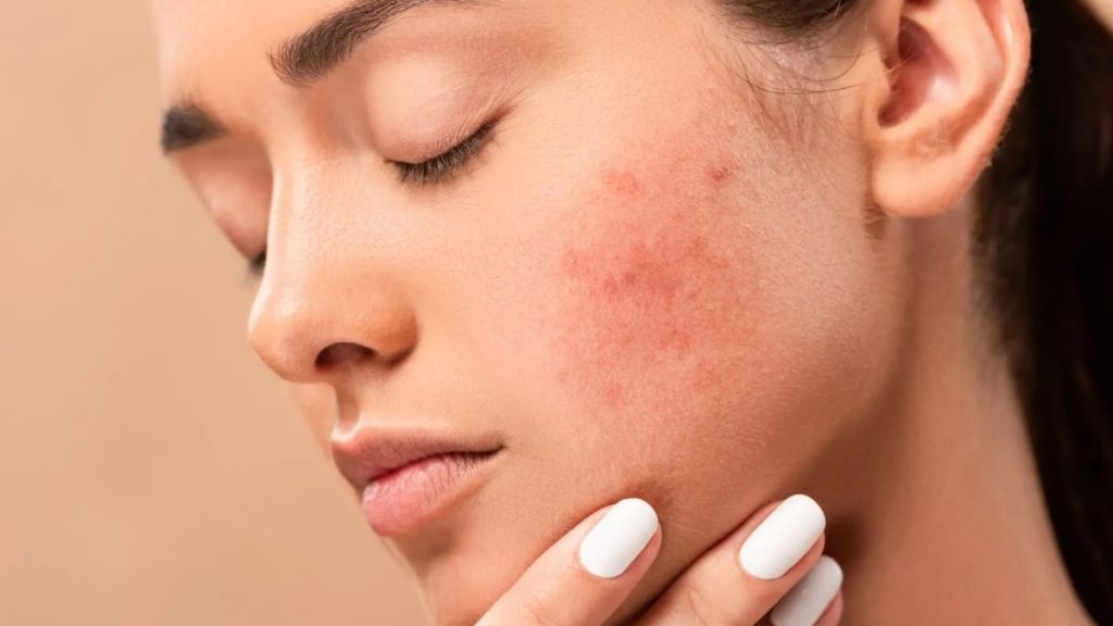 Tips For Preventing Marks On Face