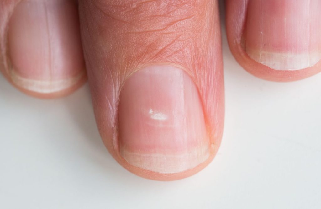 White Marks On Nail