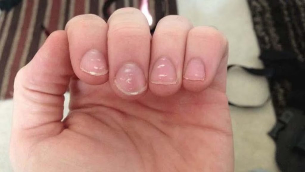 White Marks On Nail