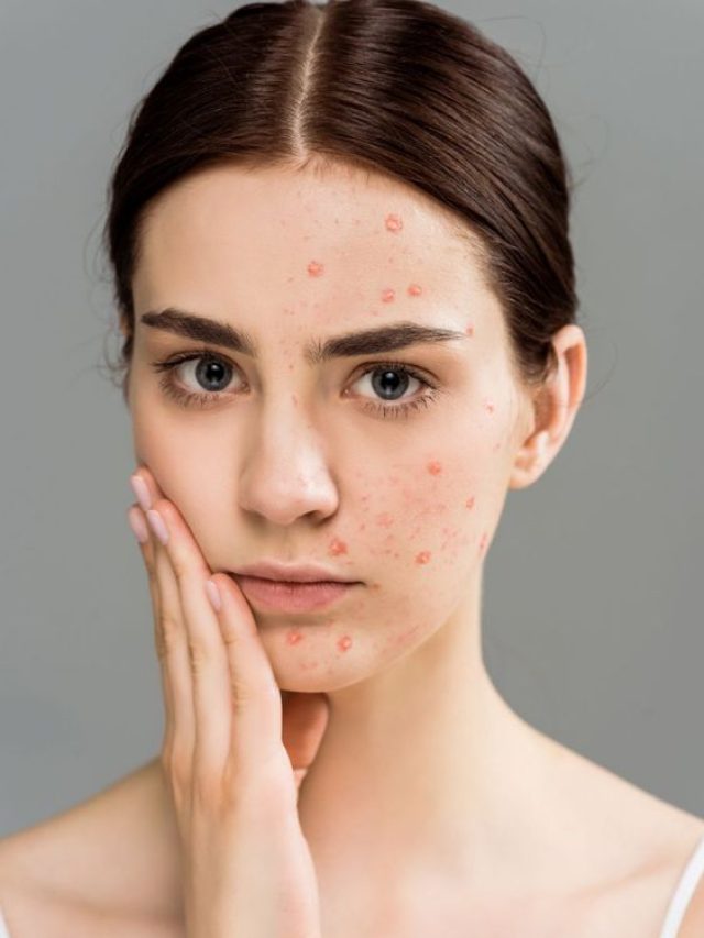 Tips for Preventing Acne