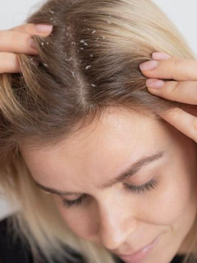 ways to get rid of dandruff