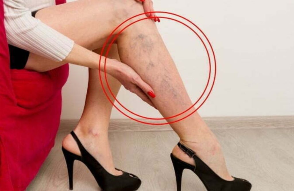 Vericose Vein Cause And Solutions 