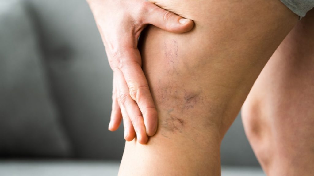 Vericose Vein Cause And Solutions