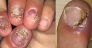 Paronychia-Home-Reamedy