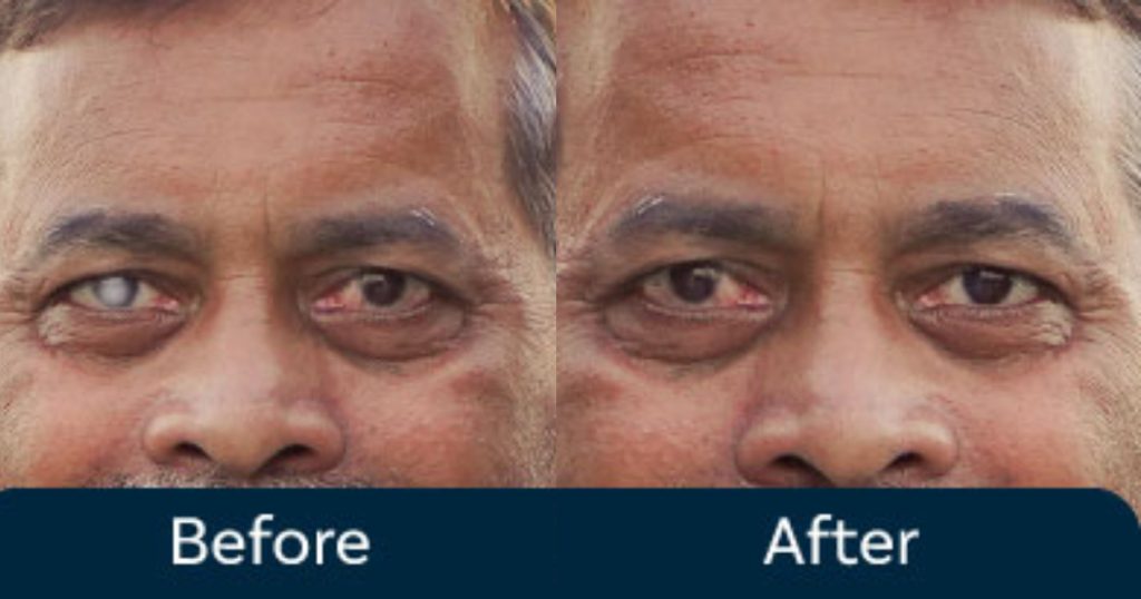 Eye-Cataract-Removal-without-Surgery